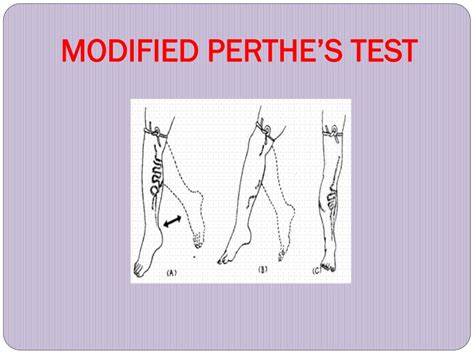 perthes test